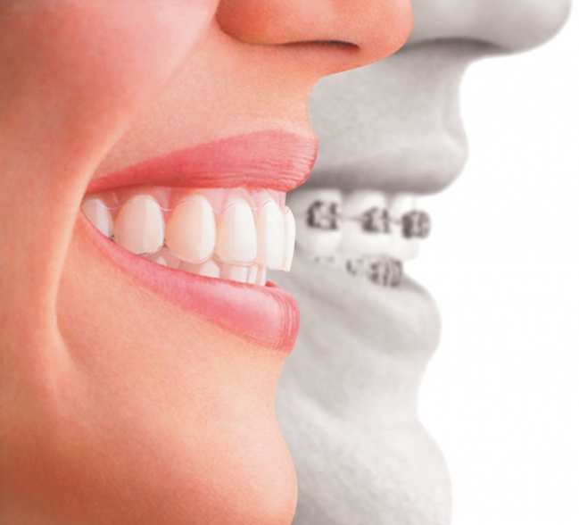 日本LH牙齒矯正系統